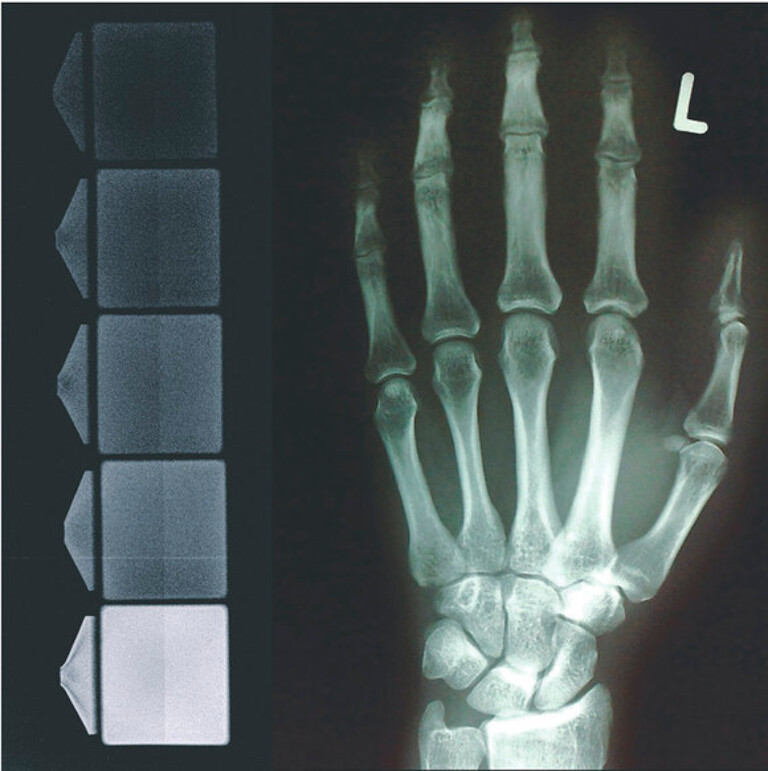 ROWALID-XR – Konzentrationsreihe zum Röntgenkontrast in Kunstsstoff, links oben unadditivert (Foto: Rowa Masterbatch)